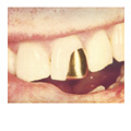 A gold capped tooth